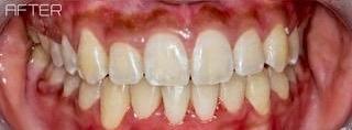 Orthodontics-After-Image