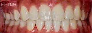 Orthodontics-After-Image