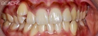 Orthodontics-Before-Image