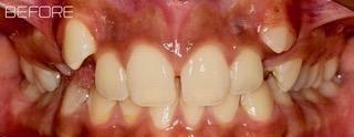 Orthodontics-Before-Image
